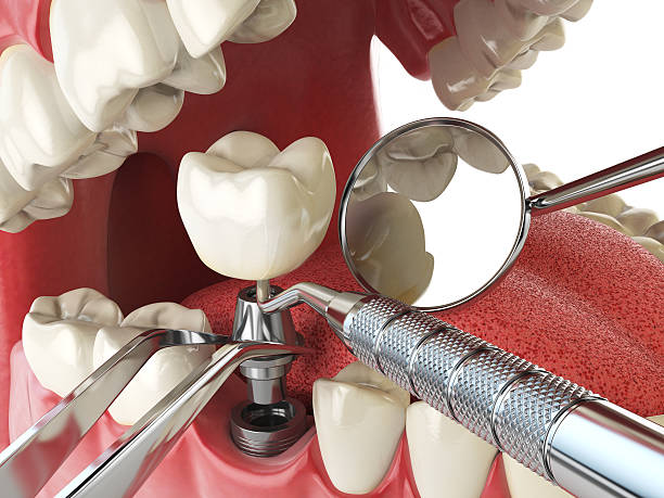 Best Emergency Root Canal Treatment in Aragon, GA